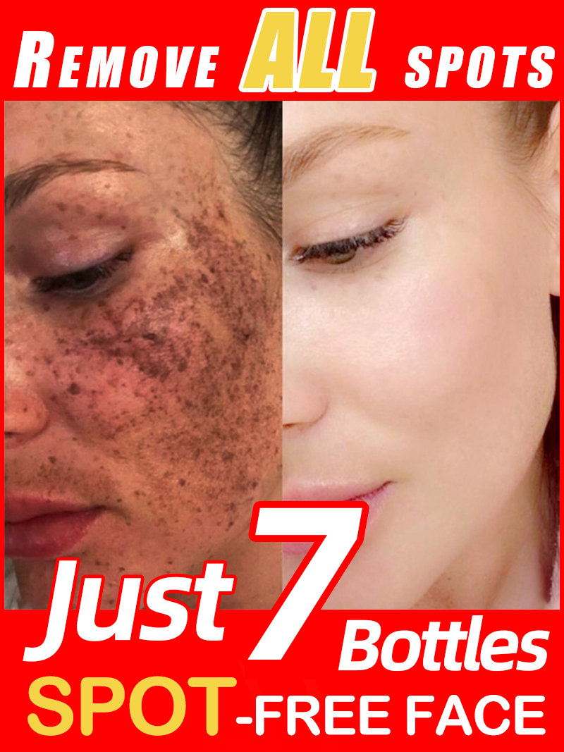 Lighten Freckles Melasma, Faci - огляд і ціна Luxury Natural Skincare